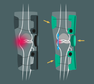 dziełanie ortezy na zwyrodnienie stawu kolanowego oa go donjoy